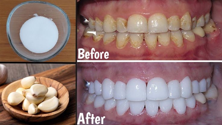 Whiten Them with This Simple