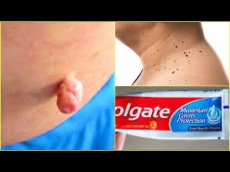 Skin Tags & Plantar Warts